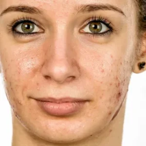 Apply These 5 Secret Techniques To Improve Fungal Acne